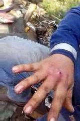 Se Reventó Este Grano Con Un Palillo Y Esto Fue lo Que Paso Después.