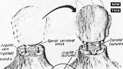 World's First Head Transplant