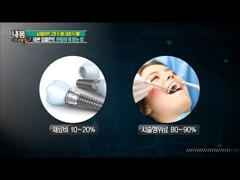 비싼 임플란트 가격! 실패하지 않는 방법! [내 몸 사용설명서] 114회 20160805