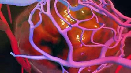 Le cancer du foie expliqué en vidéo
