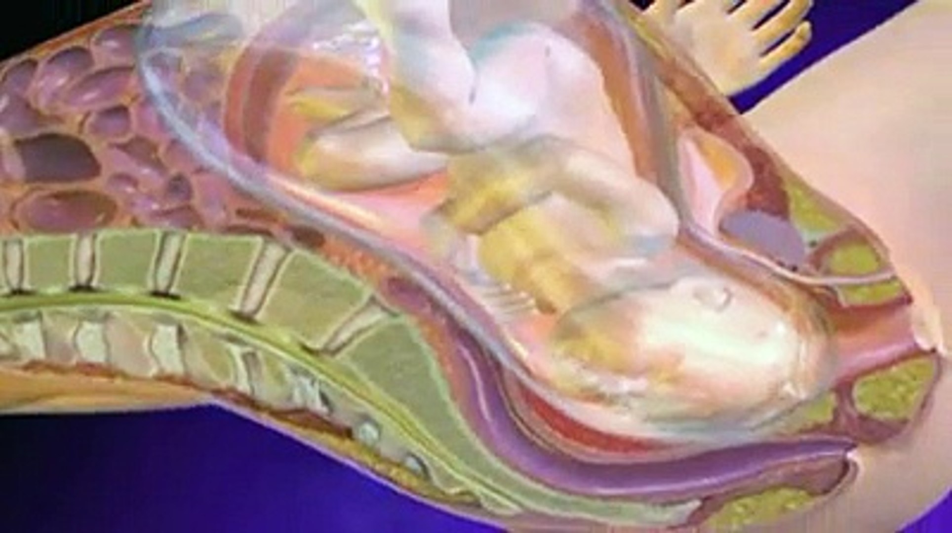 Syndrome d'aspiration mconiale