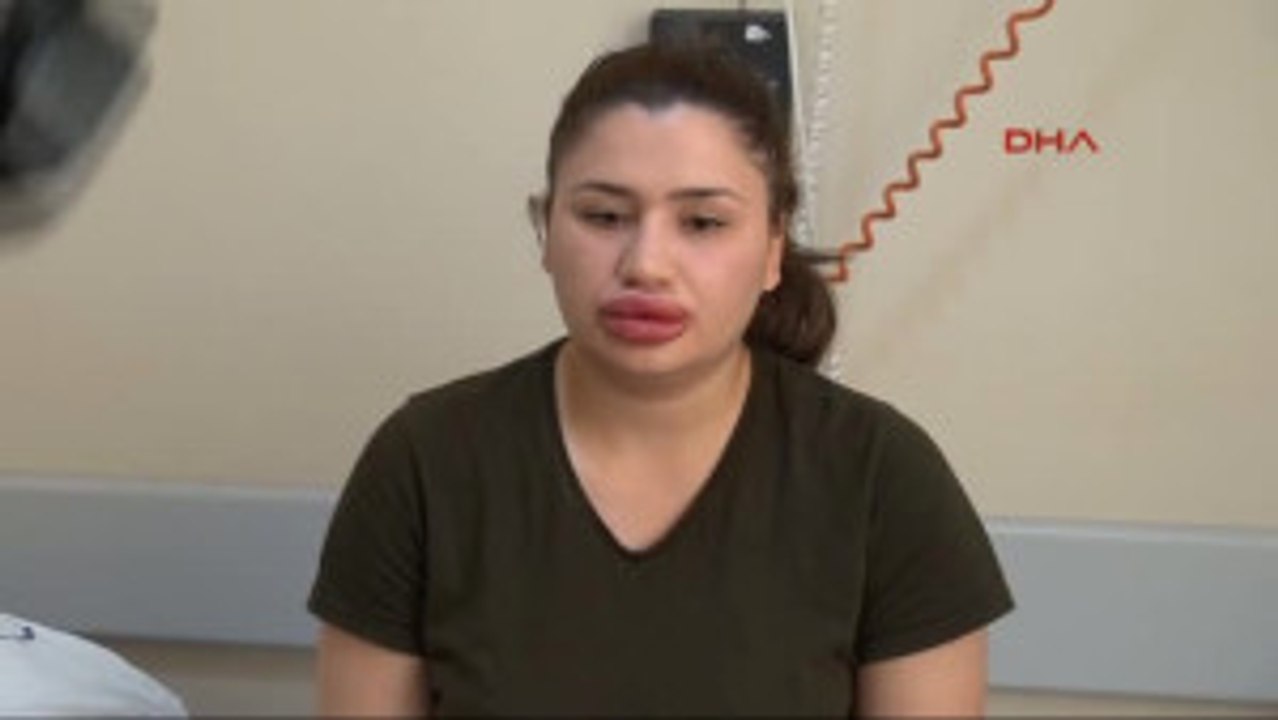 Adana Dolgu Yaptırdığı Dudakları Şişen Hemşire Çok Pişman