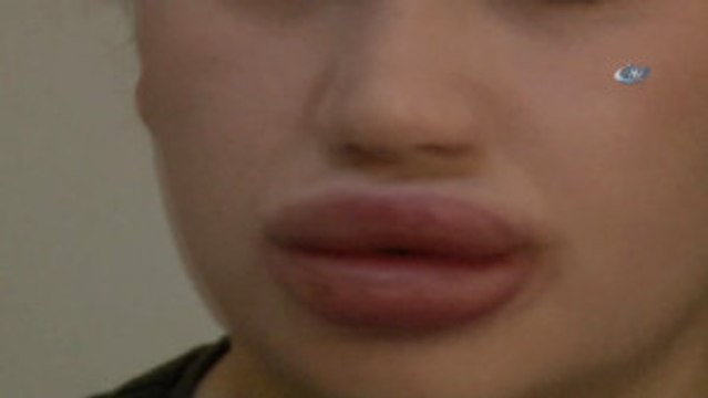 Silikon Faciası Kurbanı Hemşirenin Estetik Uzmanı Kuaför Çıktı