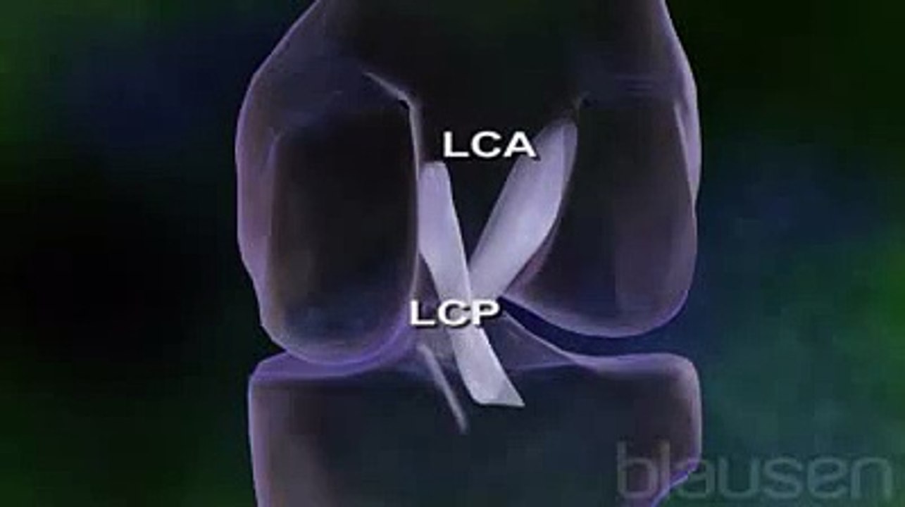 La rupture du ligament croisé antérieur expliquée en vidéo