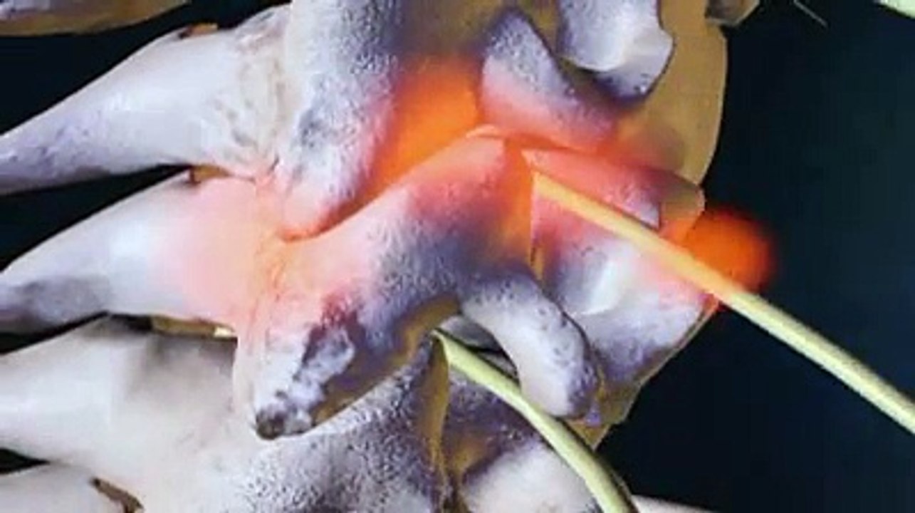 Articulations facettaires