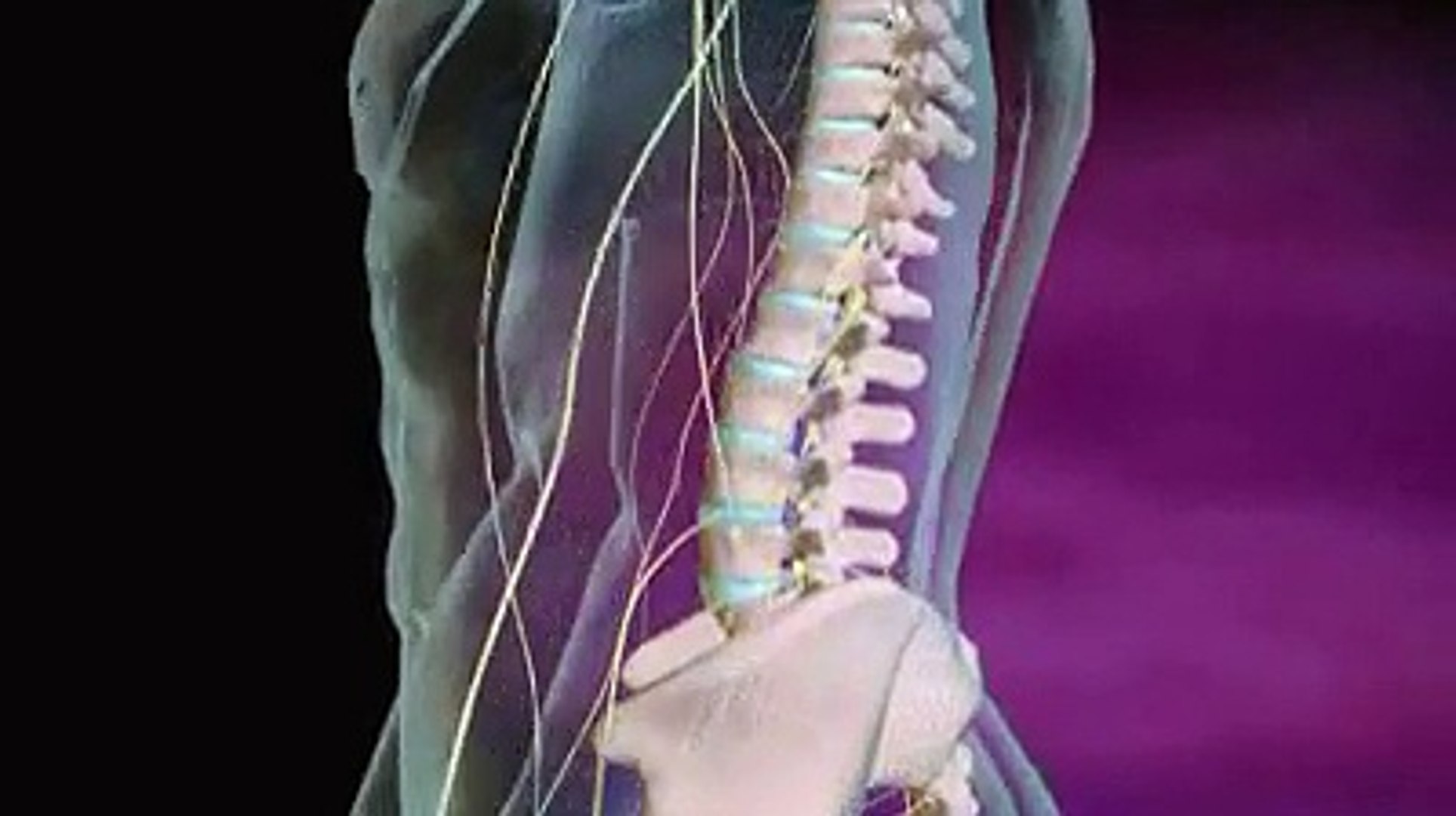 L'arthrodèse lombaire expliquée en vidéo
