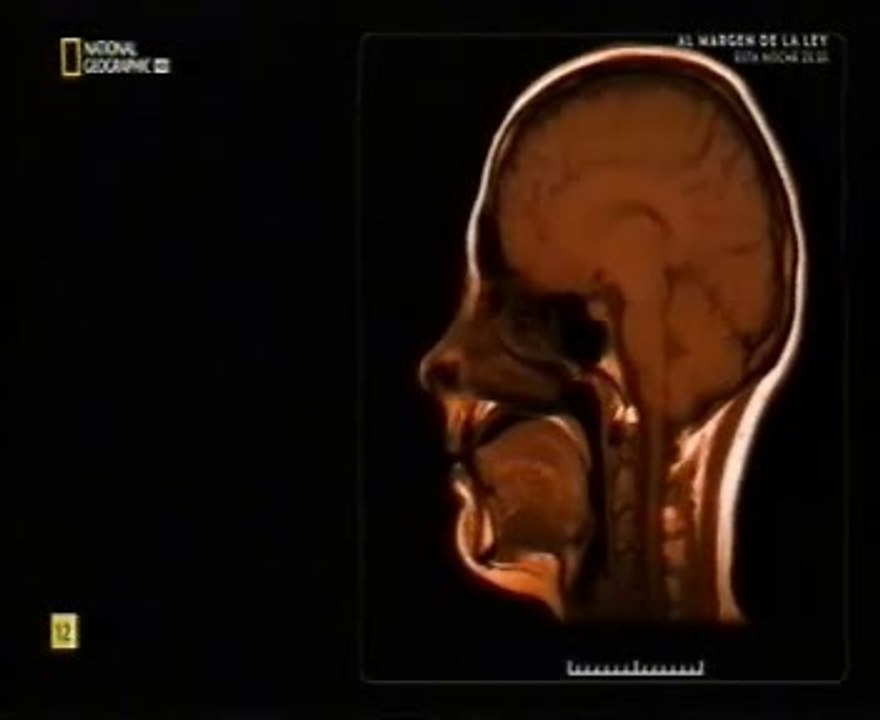 Testosterona: Cerebro transgenero