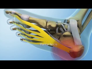 Plantar Fascia-Specific Stretching Program