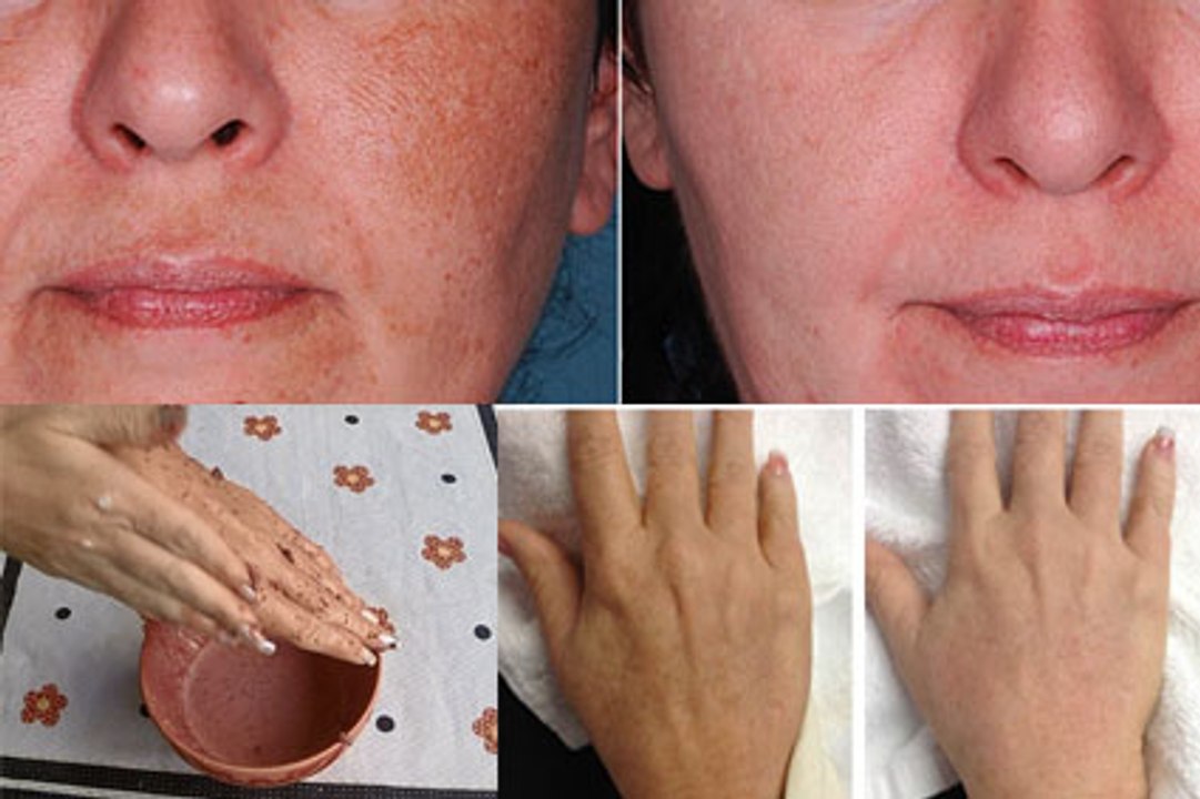 Como ter a PELE ROSADA e sem MANCHAS, como ter uma pele lisinha e sem rugas receita caseira