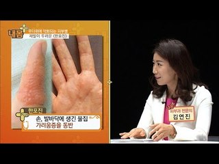 한포진? 우리가 몰랐던 물집 습진![내 몸 플러스] 14회 20160710