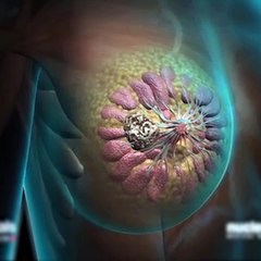 Il invente un soutien-gorge qui détecte le cancer du sein
