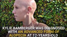 Bride Rocks Bald Head On Wedding Day
