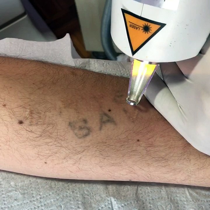 #Kalıcı #Dövme #Silme #adapazarı #sakarya #tattooremove #ndyag #qswitch #düzcedövme #duzcekaşsilme #dövmesilimi #karasu #removal #barış #yüksek