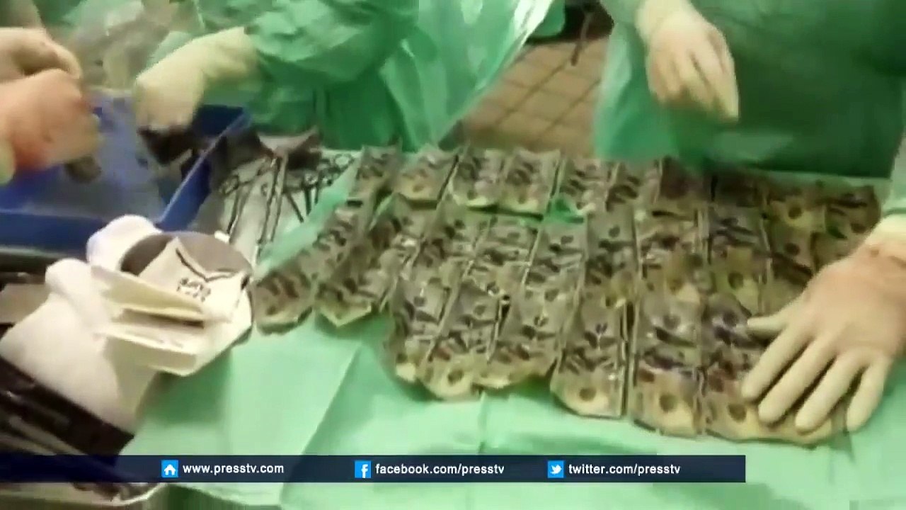 Mauvaise cachette   les médecins retrouvent 7000$ dans l'estomac d'une femme