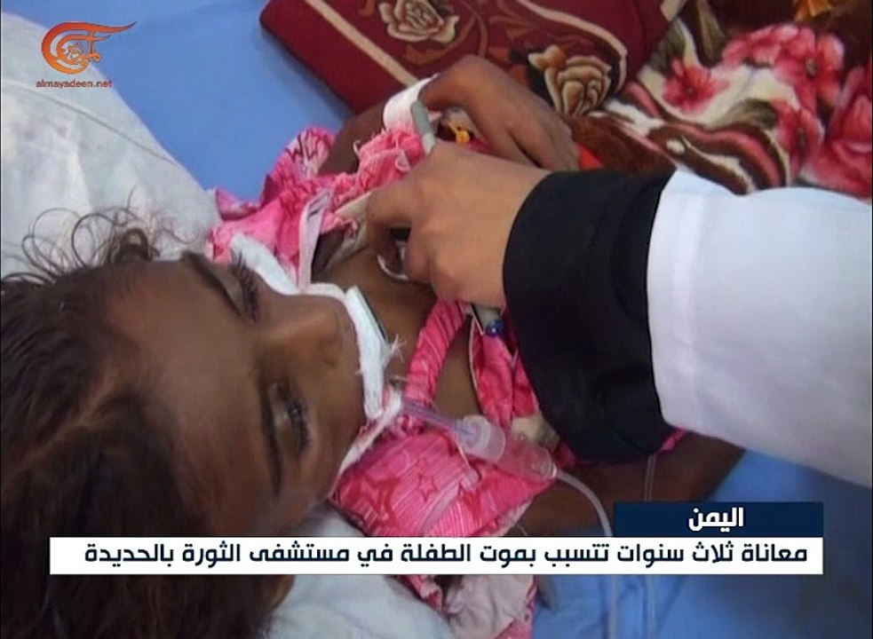 سوء التغذية يقتل الطفلة اليمنية جميلة