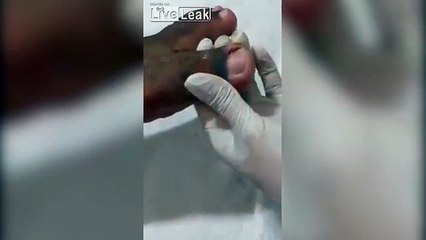 Mjeku heq thoin e futur në mish, ajo që i del nga gishti është e pabesueshme