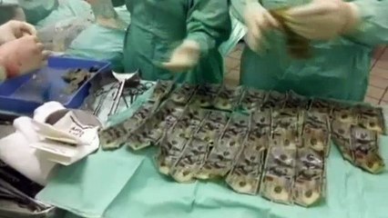 incroyable découverte dans son estomac