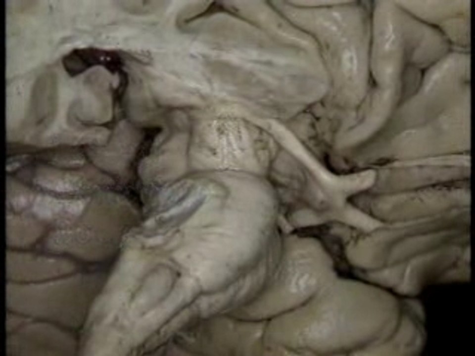 Brainstem 2