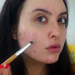 I hoqi aknet për 60 sekonda, vetëm me këtë përbërës…