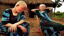 Mira lo que le Hacen a los Albinos en Africa!