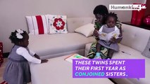 Previously conjoined sisters are now able to walk-DYhQ-dOY