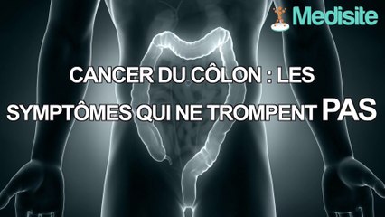 Cancer du côlon : les symptômes qui ne trompent pas