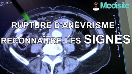 Rupture d'anévrisme : reconnaître les signes