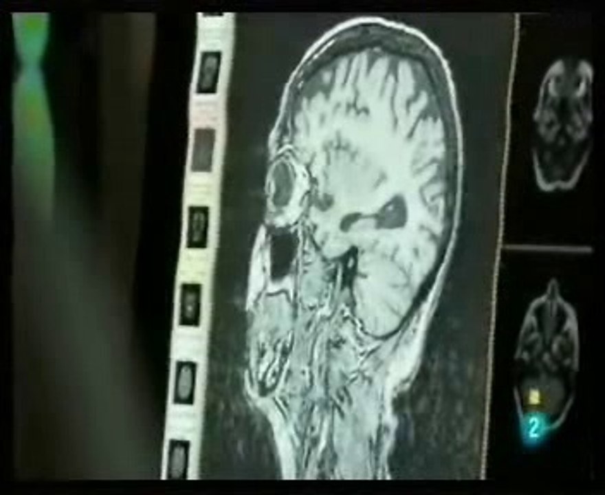 DTA: Demencia tipo Alzheimer