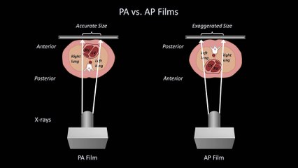 How to Interpret a Chest X-Ray (Lesson 5 - Cardiac Silhouette and Mediastinum)
