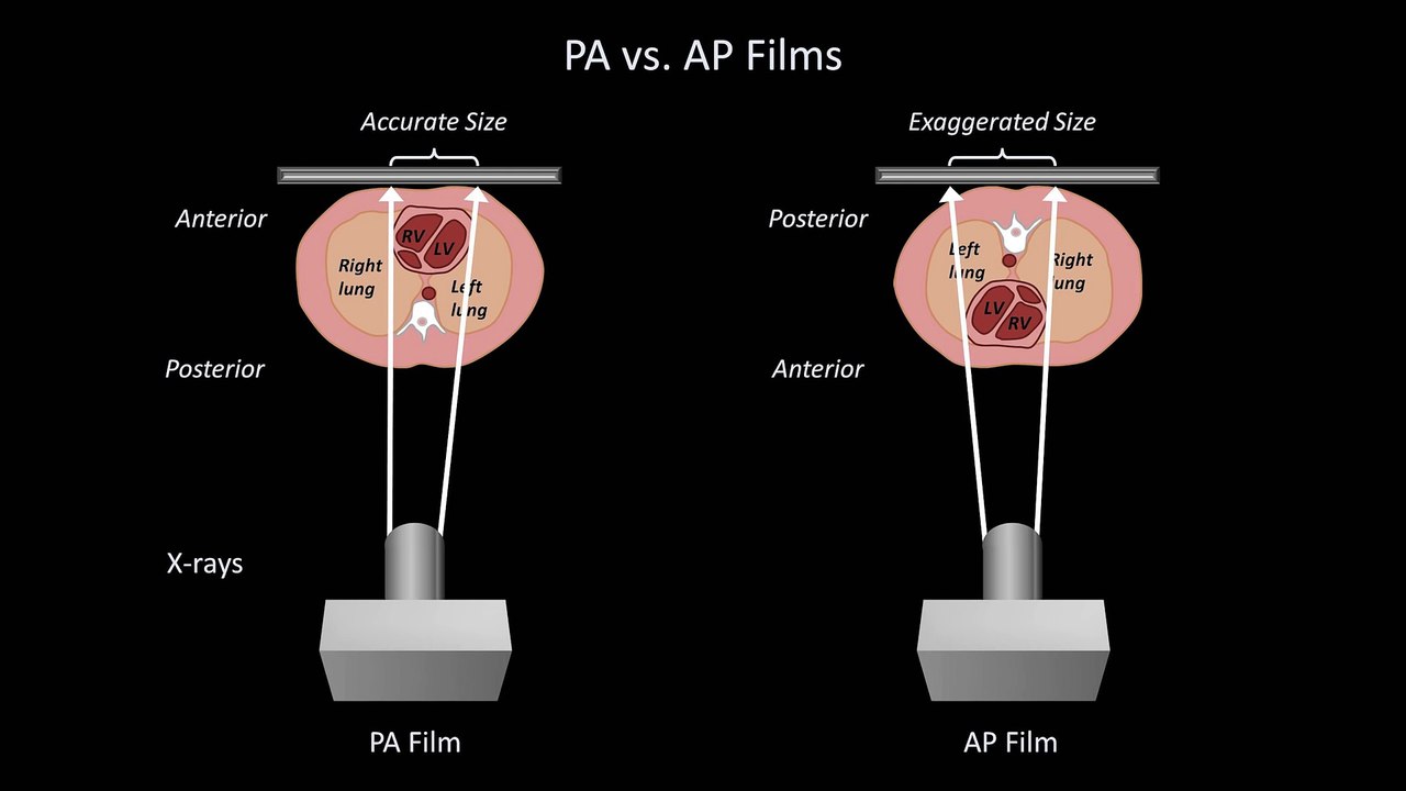 How to Interpret a Chest X-Ray (Lesson 5 - Cardiac Silhouette and Mediastinum)