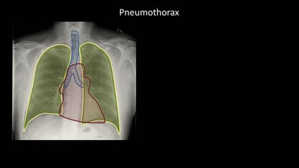 How to Interpret a Chest X-Ray (Lesson 6 - Diaphragm and Pleura)