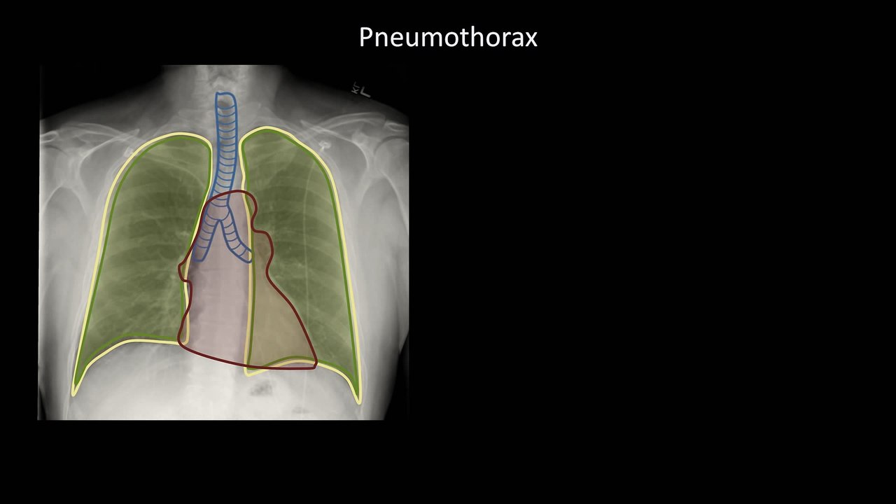 How to Interpret a Chest X-Ray (Lesson 6 - Diaphragm and Pleura)