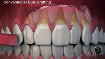 Conventional Gum Grafting vs Chao Pinhole Surgical Technique Female Voice Over