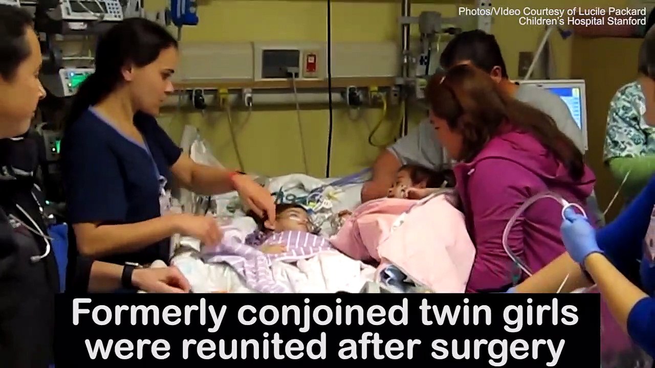 The moment conjoined twins see each other after