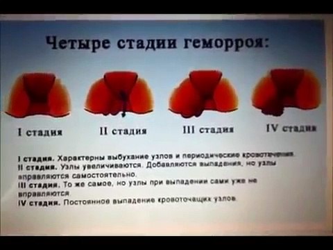 Народные средства от геморроя. Эффективное средство от геморроя. Как лечить геморрой дома