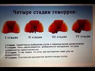 Народные средства от геморроя. Эффективное средство от геморроя. Как лечить геморрой дома