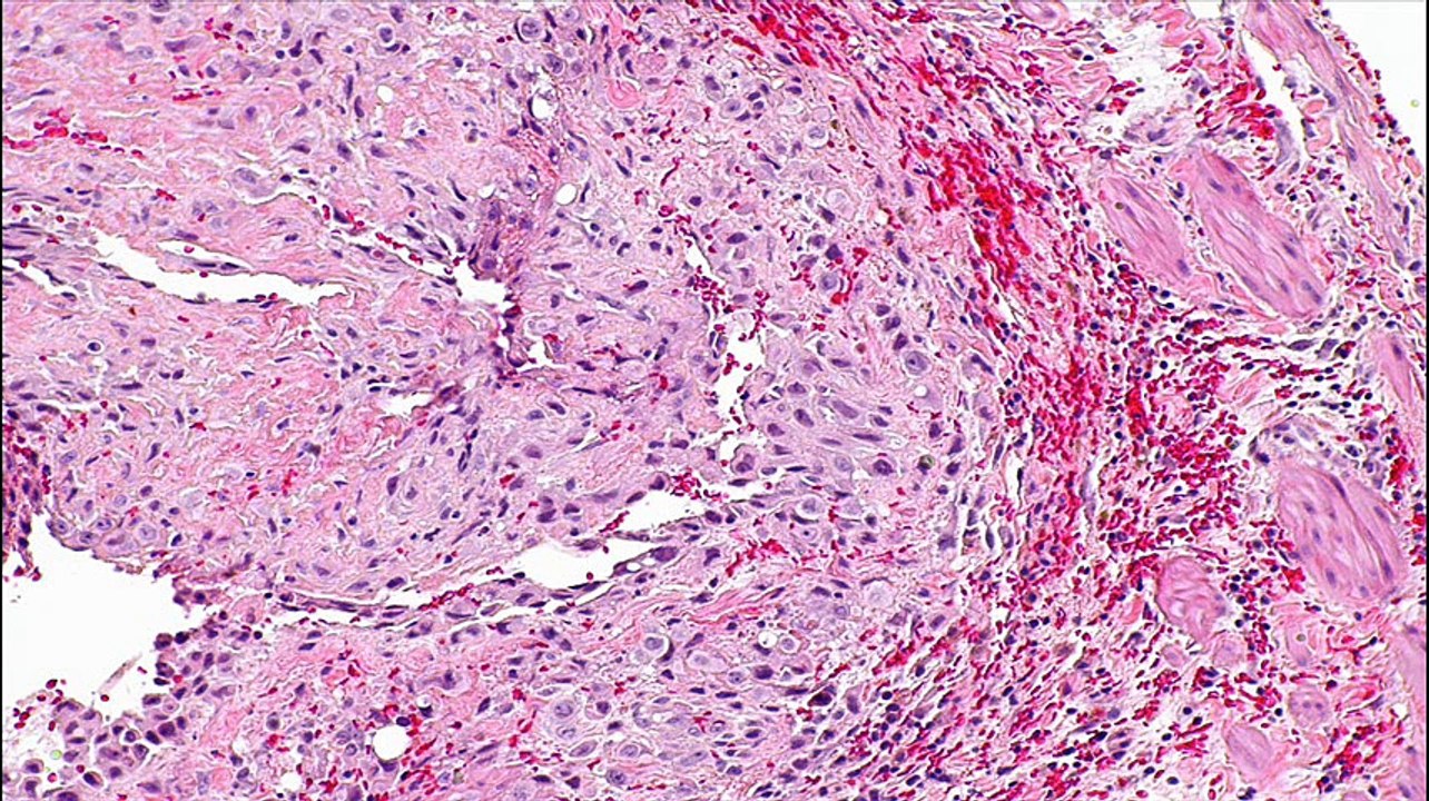 Ectopic decidua