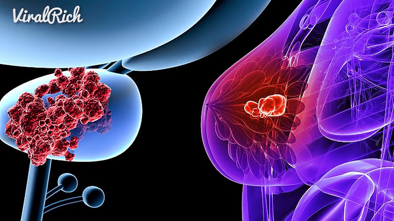 5 Señales de cáncer de mama que casi todas las mujeres ignoran...