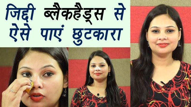 Blackheads | Home Remedy | DIY | जिद्दी ब्लैकहैड्स से ऐसे पाएं छुटकारा । Boldsky