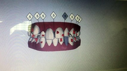 Clean Check Invisalign