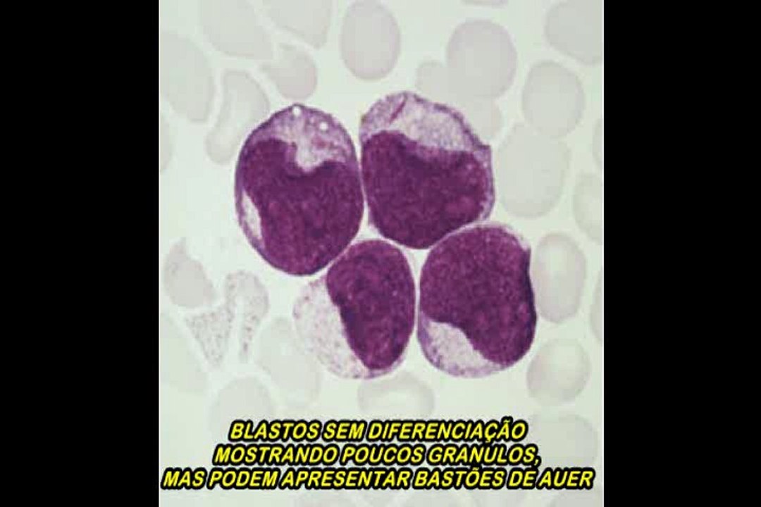 Atlas de hematologia mostrando exemplos morfológicos de leucemia mieloide aguda