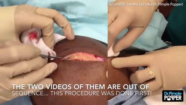Dr Pimple Popper removes lump the size of a BOWLING BALL from man's neck