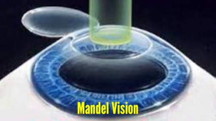 Lasik Manhattan NY - Mandel Vision (888) 866-3681