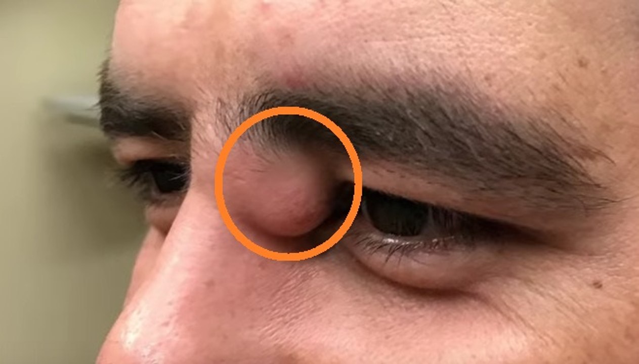 Este homem tinha uma protuberância perto do olho direito…Quando a médica a abriu, ficou sem fôlego!