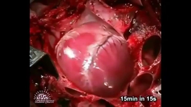 Kalp Krizi Geçirirken Kalp Nasıl Olur?