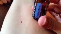 Cette vidéo qui montre comment retirer une tique pourrait en fait donner la maladie de Lyme
