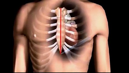 Open Heart  bypass surgery in Delhi