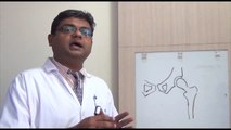 Diseases of Hip Joint Cured by Dr. Vibhore Singhal at Bensups Hospital, Dwarka, New Delhi