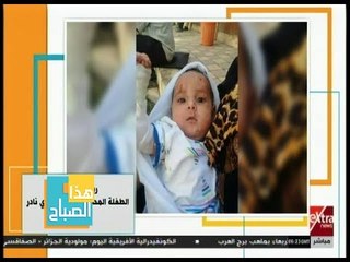هذا الصباح | ريتاج .. طفلة عمرها 4 أشهر مصابة بمرض جلدي نادر