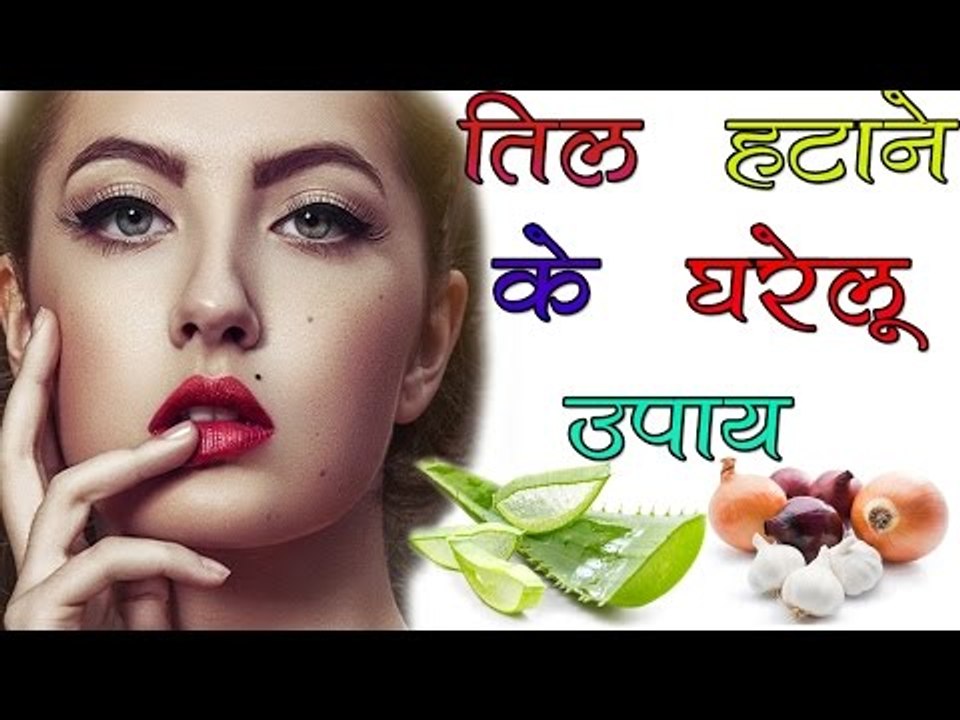 तिल हटाने के घरेलू उपाय || Home Remedies For Warts Removal || Health Tips By Shristi